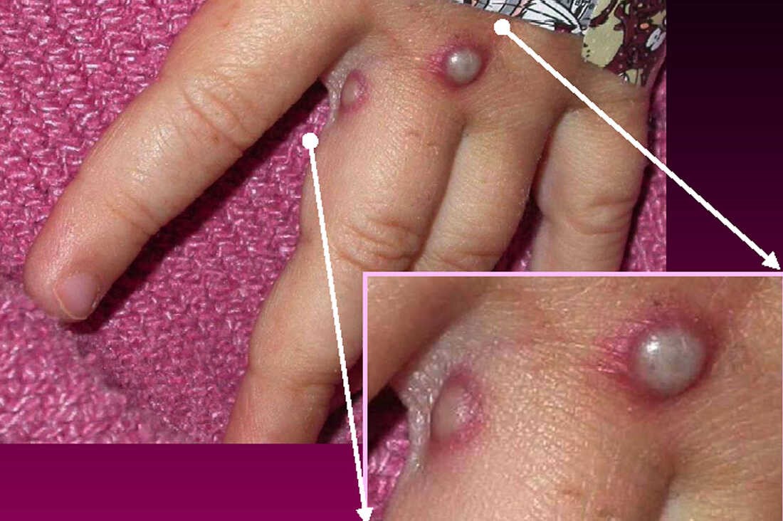 Bệnh đậu mùa khỉ - 15
