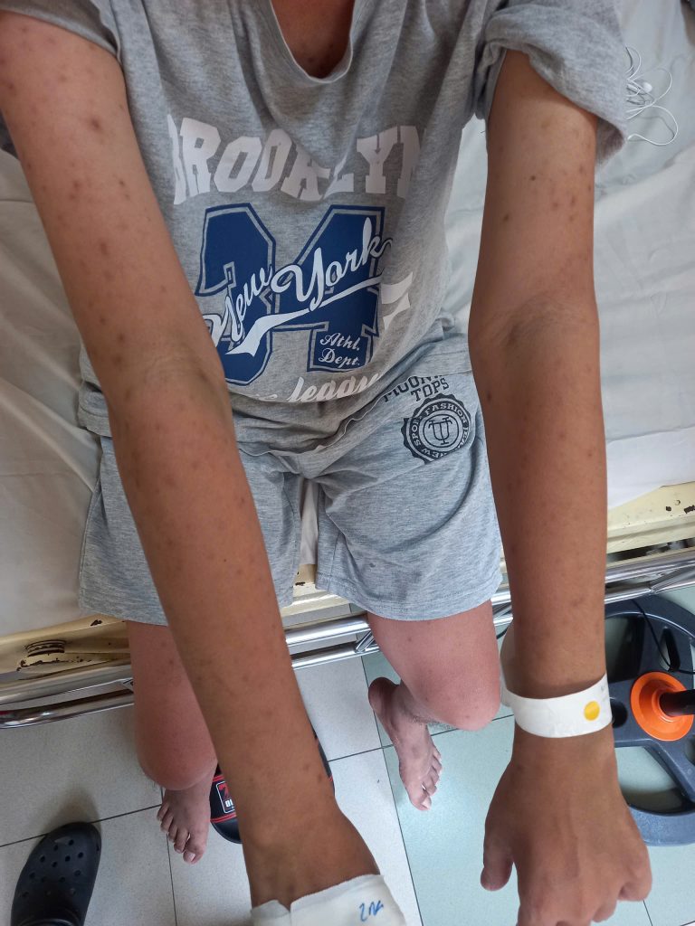 NHIỄM NẤM HISTOPLASMA 2